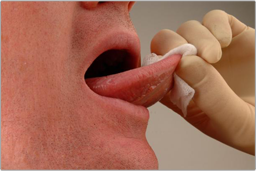 Mouth Cancer Soft Tissue