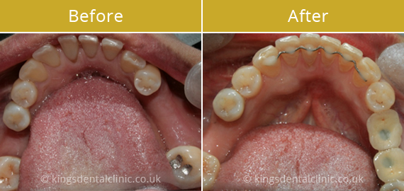 Inman Aligners Hammersmith Kings Dental Clinic
