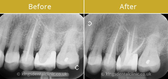 Root Canal Therapy