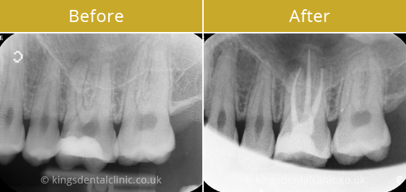 Root Canal Therapy