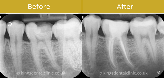 Root Canal Therapy