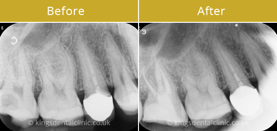 Root Canal Therapy