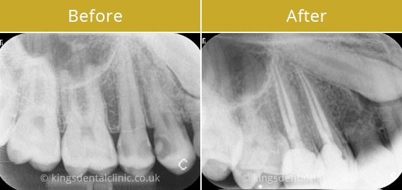 Root Canal Therapy