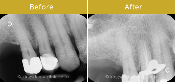 Root Canal Therapy