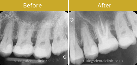 Root Canal Therapy