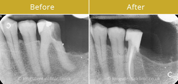 Root Canal Therapy