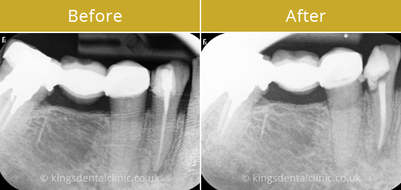 Root Canal Therapy