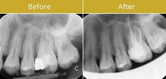 Root Canal Therapy