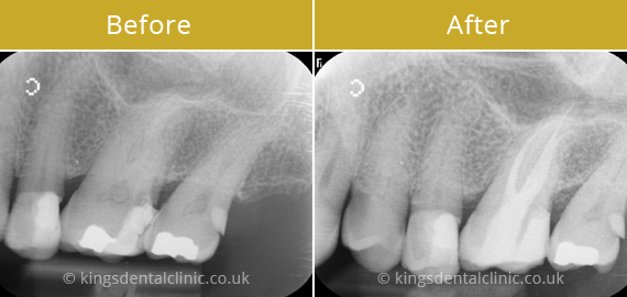 Root Canal Therapy