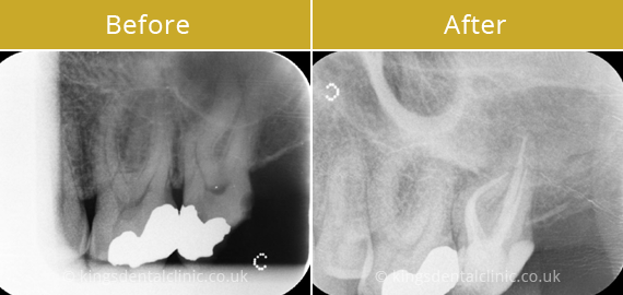 Root Canal Therapy