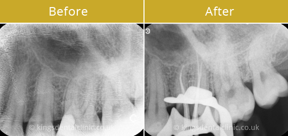 Root Canal Therapy