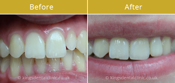 Porcelain Veneers