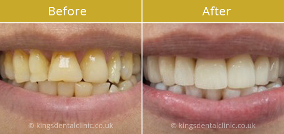 Porcelain Veneers