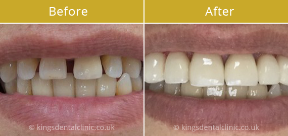 Porcelain Veneers