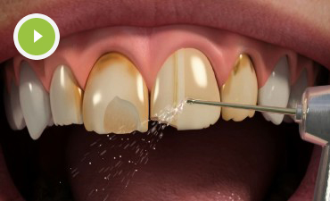 Porcelain Veneers